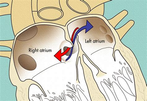 how to say foramen ovale.